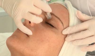 Micro needling