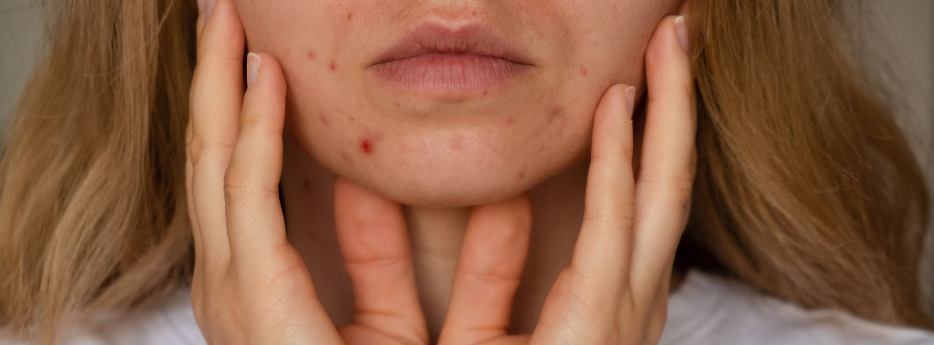 Traitement contre l’acné